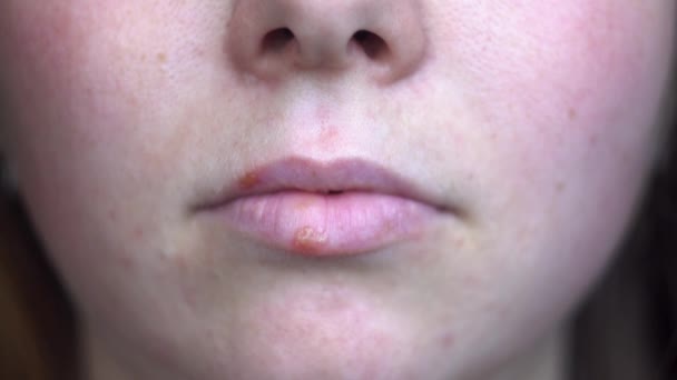 Primer plano de los labios femeninos infectados por el virus del herpes. Medios. Concepto de medicina e inmunología, cara femenina infeliz con manchas rojas en los labios. — Vídeos de Stock