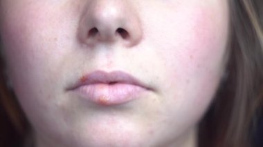 Genç bir kızın dudaklarında uçuk hastalığı var. Medya. Kadın, virüs noktaları, ilaç ve hastalık kavramlarıyla ilgili detaylarla yüzleşiyor..