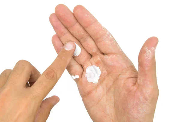 Man Applying Moisturizer Cream Hands Dry Skin — Stock Photo, Image