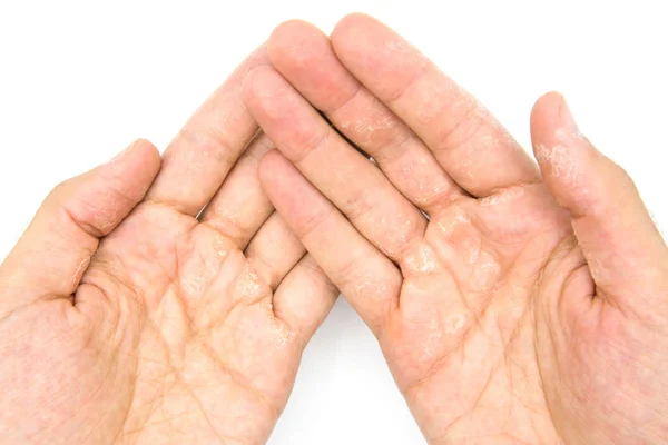 Man Zastosowaniu Kremu Nawilżającego Ręce Suchość Skóry — Zdjęcie stockowe