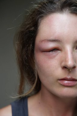 Eşek arısı sokmasından dolayı gözü şişmiş beyaz bir kadın. Eşek arısı ısırığına alerji reaksiyonu.