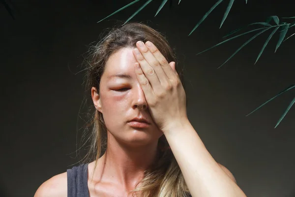 Junge Kaukasierin Mit Einem Geschwollenen Auge Nach Einem Wespenstich Allergische — Stockfoto