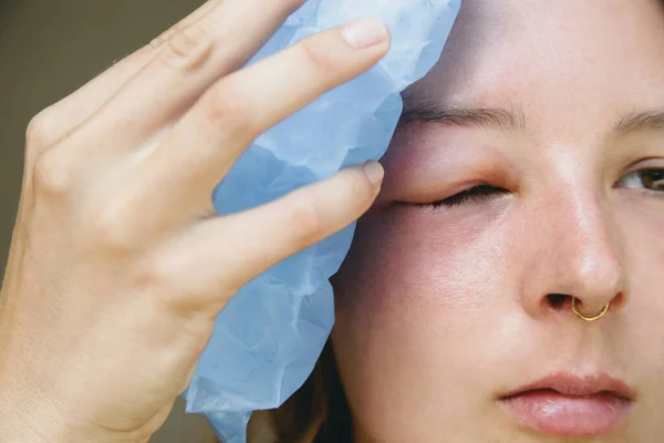 Young caucasian woman with a swollen eye from a wasp\'s sting. Allergy reaction on wasp bite.