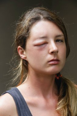 Eşek arısı sokmasından dolayı gözü şişmiş beyaz bir kadın. Eşek arısı ısırığına alerji reaksiyonu.