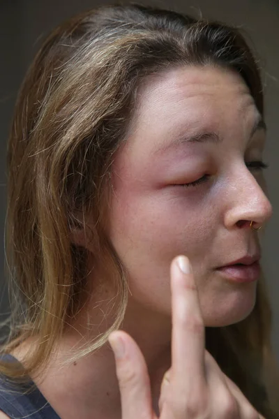 Young caucasian woman with a swollen eye from a wasp\'s sting. Allergy reaction on wasp bite.