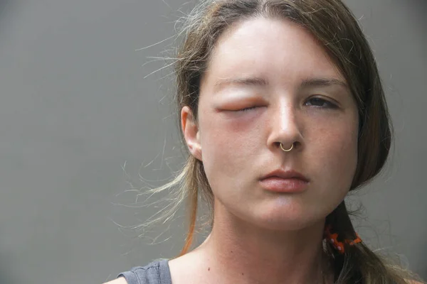 Mulher Caucasiana Jovem Com Olho Inchado Picada Uma Vespa Reação — Fotografia de Stock