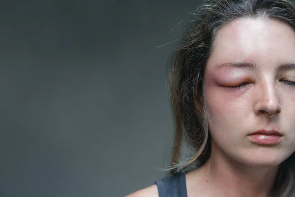 Mulher Caucasiana Jovem Com Olho Inchado Picada Uma Vespa Reação — Fotografia de Stock