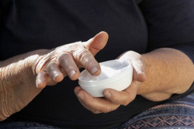 Kollarına nemlendirici losyon süren çok kuru ciltli yaşlı bir kadın.