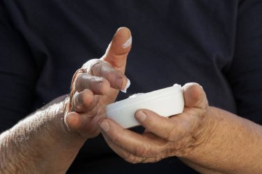 Kollarına nemlendirici losyon süren çok kuru ciltli yaşlı bir kadın.