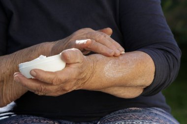 Kollarına nemlendirici losyon süren çok kuru ciltli yaşlı bir kadın.