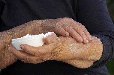 Kollarına nemlendirici losyon süren çok kuru ciltli yaşlı bir kadın.