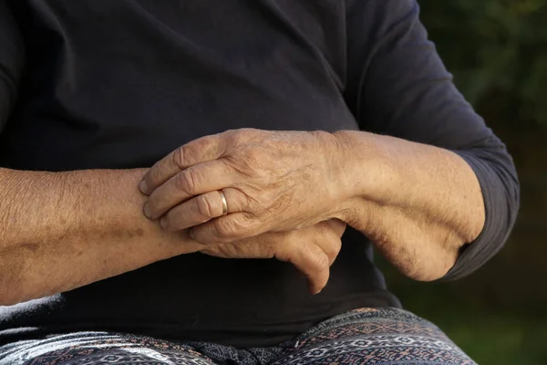 Oudere Blanke Vrouw Krabt Droge Huid Haar Arm Oudere Droge — Stockfoto