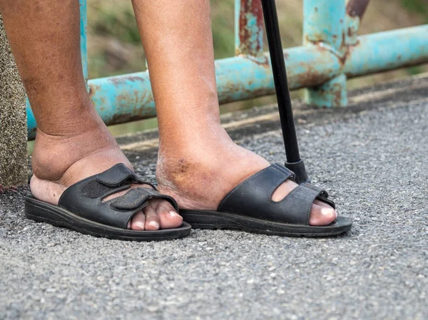 Los Pies Del Hombre Con Diabetes Aburridos Hinchados Debido Toxicidad — Foto de Stock