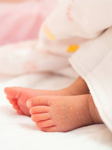 Closeup Instep Foot Newborn Skin Peeling White Cloth Skin Allergies — Stock Photo, Image