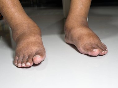 Şeker hastası insanların ayakları, donuk ve şişmiş. Beyaz bir zemin üzerine yerleştirilen diyabetin zehirliliği nedeniyle.