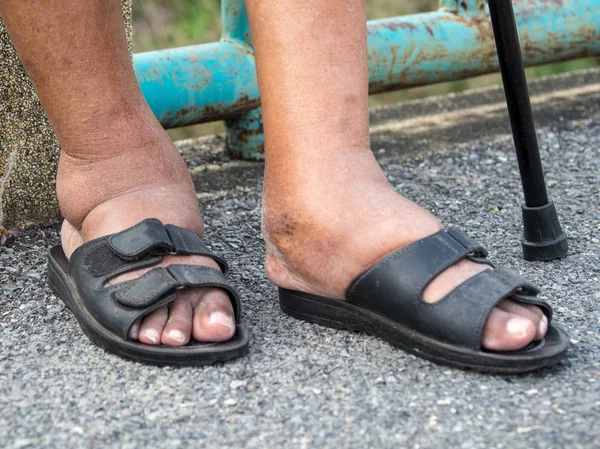 Die Füße Von Menschen Mit Diabetes Stumpf Und Geschwollen Aufgrund — Stockfoto