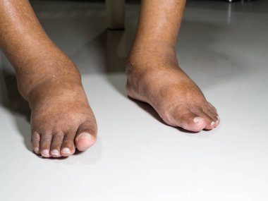 Şeker hastası insanların ayakları, donuk ve şişmiş. Beyaz bir zemin üzerine yerleştirilen diyabetin zehirliliği nedeniyle.