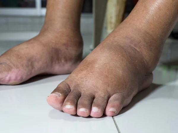 Les Pieds Des Diabétiques Ternes Gonflés Raison Toxicité Diabète Placé — Photo