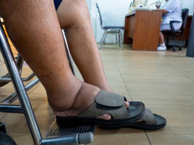 Ayak şişmesi ile şeker hastalığı ve böbrek hastalığı olan erkekler. Ayakkabı giymek değil. onun tedavisi için bir doktor görmek bir savaş için hastanede tekerlekli sandalyede olduğunu.