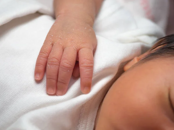 一个新生儿的特写手 皮肤脱皮白色布 新生儿皮肤过敏称为胎儿皮脂 医疗保健理念 — 图库照片