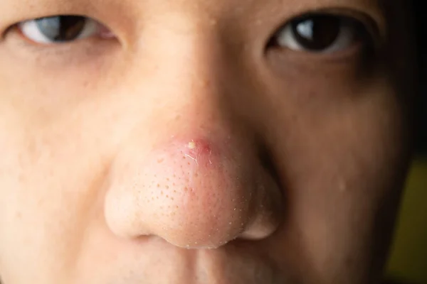 封闭许多黑头粉刺和痤疮疤痕在亚洲皮肤脸的鼻子 — 图库照片