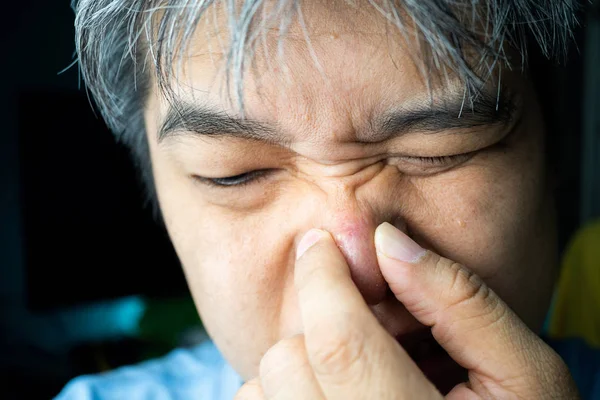 亚洲人正在挤压他鼻子上的粉刺 黑头和痤疮疤痕 — 图库照片