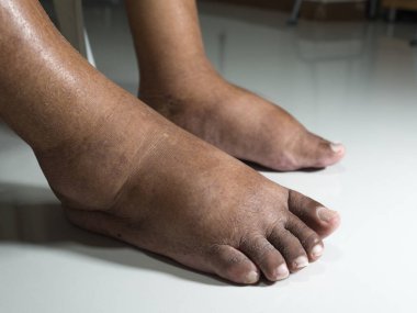 Şeker hastası insanların ayakları, donuk ve şişmiş. Beyaz bir zemin üzerine yerleştirilen diyabetin zehirliliği nedeniyle.