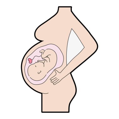 annelik içinde bebek ve ubilical kordon vektör çizim ile