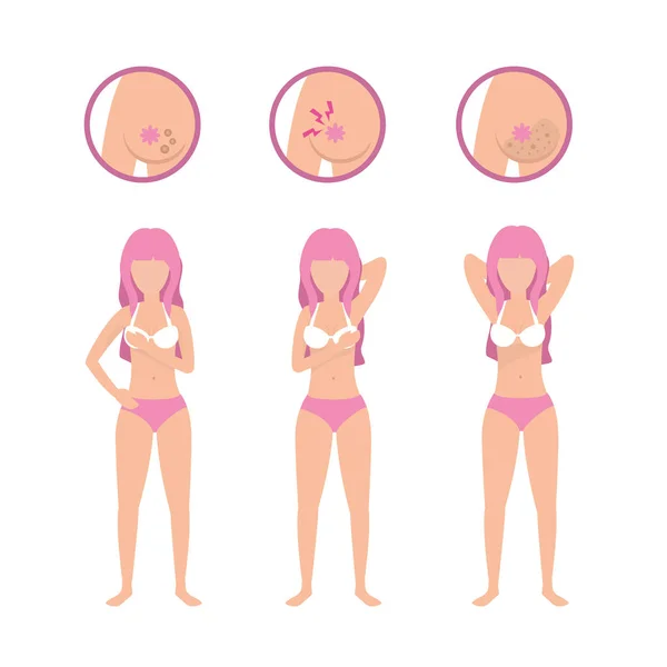 Woman Breast Cancer Illness Survivor Vector Illustration — Stock Vector