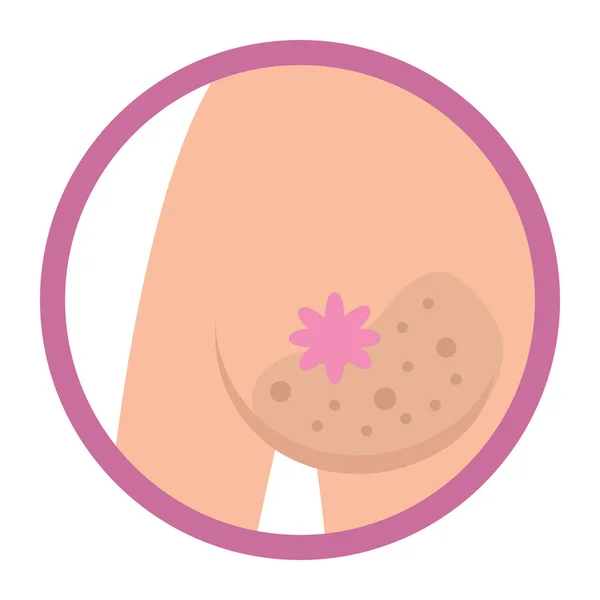 Signo de cáncer de mama — Vector de stock