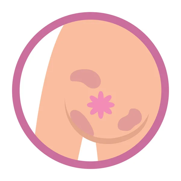 Знак раку молочної залози — стоковий вектор