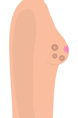 meme kanseri işaret