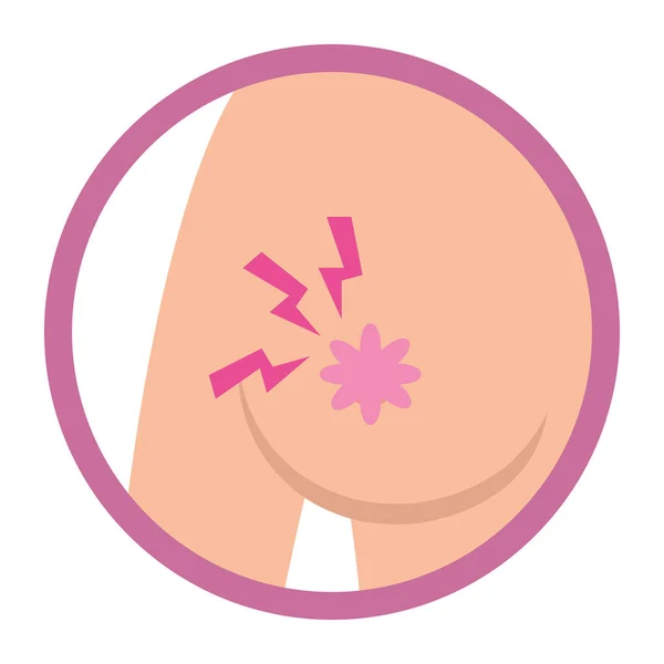 Signo de cáncer de mama — Vector de stock