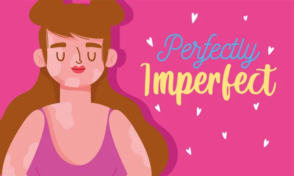 Perfect imperfect, cartoon vrouw met vitiligo ziekte — Stockvector