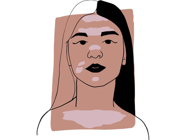 Retrato Dibujado Mano Una Joven Con Vitiligo Color Beige Oscuro — Archivo Imágenes Vectoriales