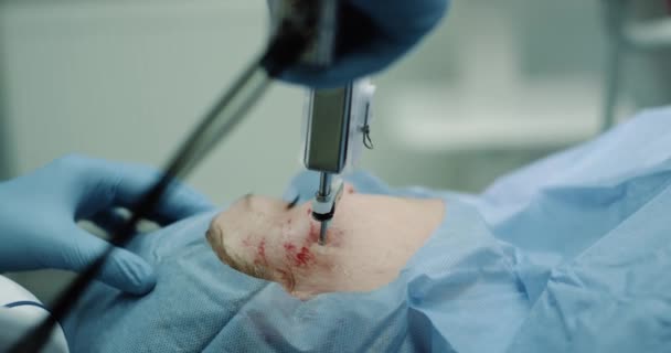 Новая технология для лица вампирской процедуры лица в современной клинике зрелая женщина пациент, микро-иглы технологии в новом изобретении. 4k — стоковое видео