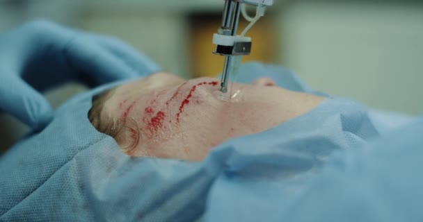 Dettagli di una nuova invenzione in medicina, vampirofacciale o prp procedura per il processo di cura della pelle di micro-needling cattura in un primo piano video . — Video Stock
