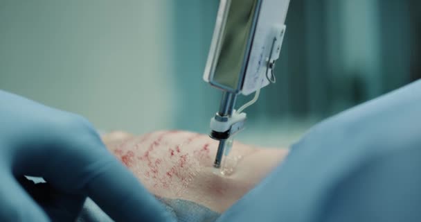 Κινηματογράφηση σε πρώτο πλάνο φροντίδας του δέρματος σε μια νέα εφεύρεση σύγχρονο ιατρείο της μεσοθεραπεία prp ή vampirefacial διαδικασία, όλες οι διαδικασίες σύλληψης λεπτομέρειες, Μικρο-διατρυπηθούν. 4k — Αρχείο Βίντεο