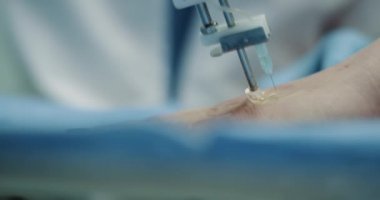 Ayrıntılar closeup vampirefacial veya prp yordamı kadın yapmak için Gençleştirme için elini onun cilt, mikro needling yeni teknoloji icat.