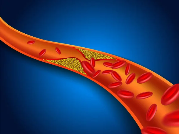 コレステロールは血管に詰まっています ベクトルEpsファイル — ストックベクタ