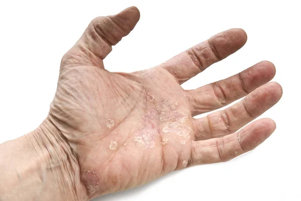 Psoriasis Bőr Betegség Ízületek Test Stock Fotó