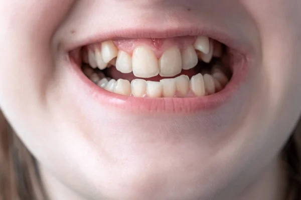 Crooked teeth close-up. Correction of malocclusion is required.