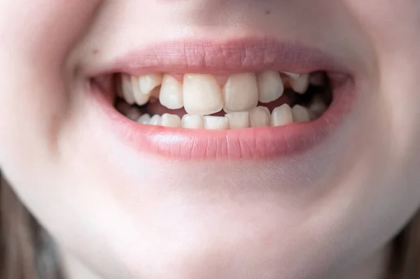 Close up of young woman\'s face with crooked teeth. Teeth before install braces. Teeth need ortodonti.