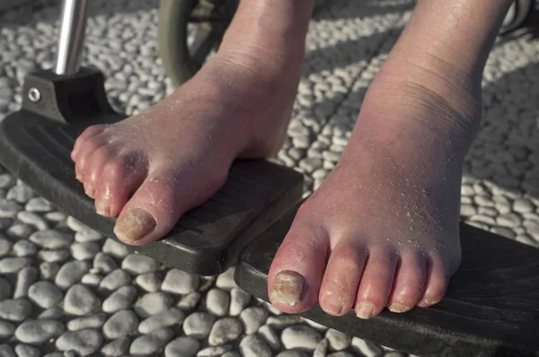 Ancianos Pies Hinchados Con Infección Fúngica Sillas Ruedas — Foto de Stock