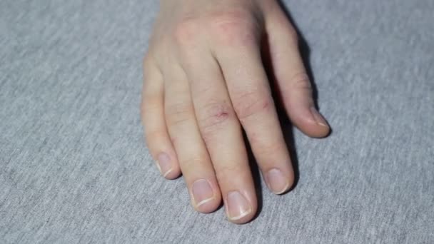 Mão Meninas Com Eczema Psoríase Fechar — Vídeo de Stock