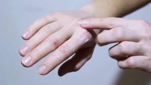 Meisje Wrijft Crème Hand Met Eczeem Psoriasis — Stockvideo