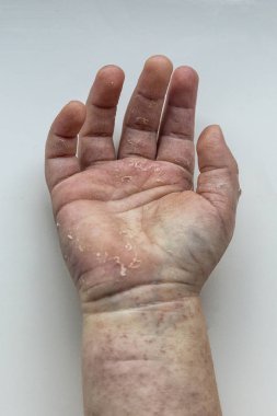 Scarlatina. Çocuk ellerimle bulaşıcı kırmızı küçük döküntü. Beyaz arka plan.