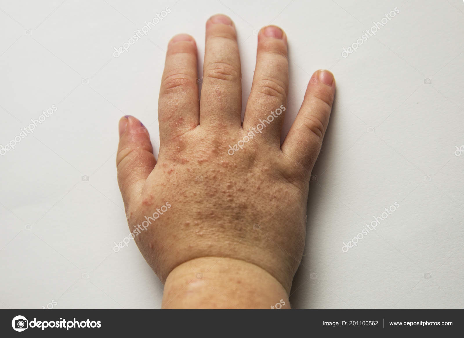 La escarlatina es contagiosa en ninos