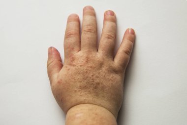 Scarlatina. Two children hands with contagious red small rash. White background. clipart