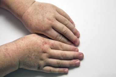 Scarlatine. Beyaz zemin üzerine kırmızı döküntü ellerle iki çocuk.